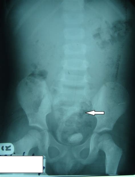 Kub X Ray Film Shows Severe Encrustations Around Ureteral Stent Renal