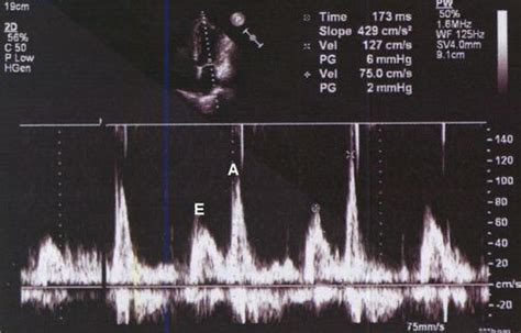 E A Reversal On Doppler Echo In Lv Diastolic Dysfunction All About