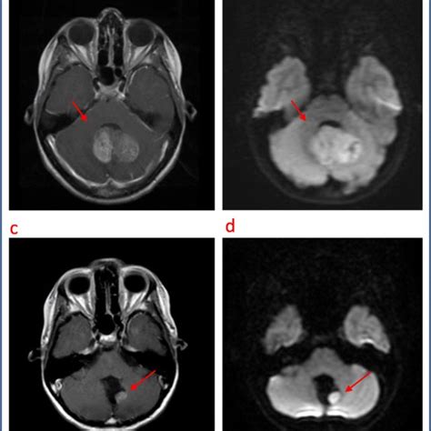 Patient Two Magnetic Resonance Imaging Mri At Initial Diagnosis A