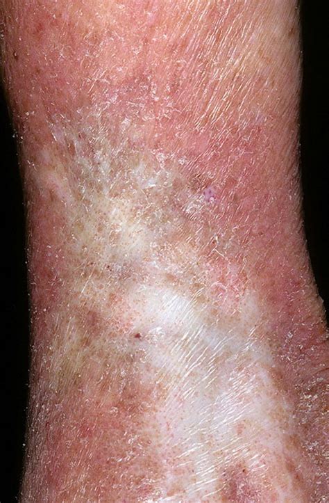 Venous Eczema Pictures 174 Photos And Images