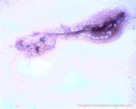 Which statement about the states of cores is wrong? Morgellons Disease Awareness - Live blood microscopy in a person suffering from Morgellons ...