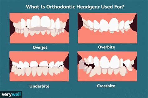 Orthodontic Headgear Purpose Uses And What To Expect