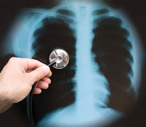 Fungal pneumonia, viral pneumonia, bacterial pneumonia and allergic pneumonia. What Are The Symptoms Of Pneumonia?