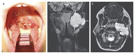 Tonsillar Asymmetry From A Parotid Tumor — Nejm