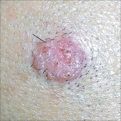 Accordingly, let us take a closer look at current and emerging modalities for recalcitrant warts. Wart on scalp | MDedge Family Medicine