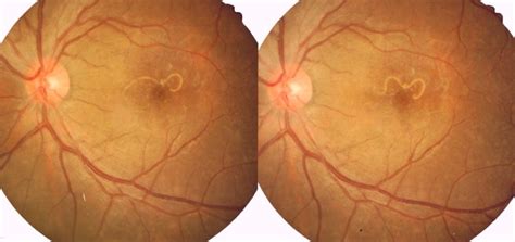 Eye Worm Causes Symptoms And Treatment Eye Parasites
