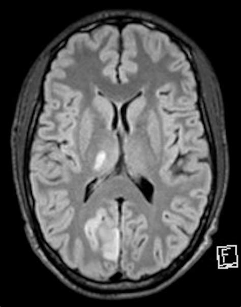 Mri Brain Diffusion Weighted Images Showing Thalamic Ischaemic Stroke