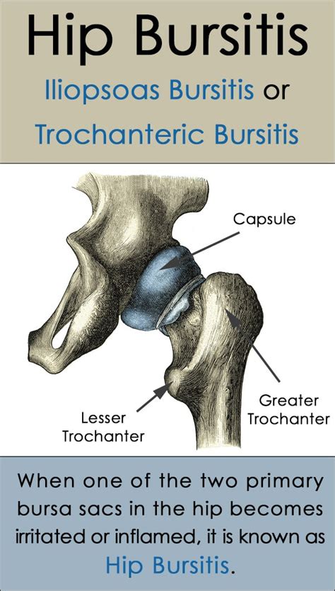 Hip Bursitis Treatment Causes And Symptoms Medical Wave