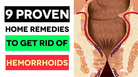 9 proven home remedies to get rid of hemorrhoids treat them with what actually works youtube