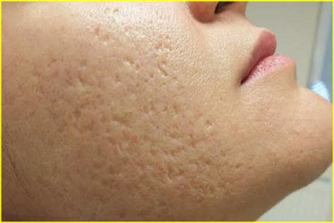 How To Get Rid Of Large Pores On Face 5 Best Home Remedies