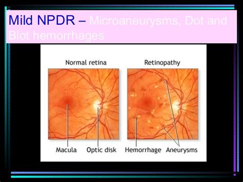 Fluid deposition under the macula, or macular edema, interferes with the macula's normal function and is a common cause of vision loss in. Diabetic retinopathy