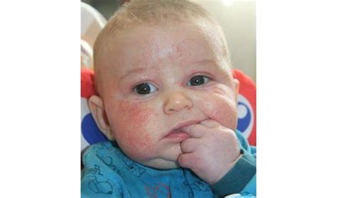 A true baby food allergy can only be diagnosed by a medical professional,such as your child's doctor or allergist. Dr Dina Kulik Skin allergic reaction like this? Could be ...