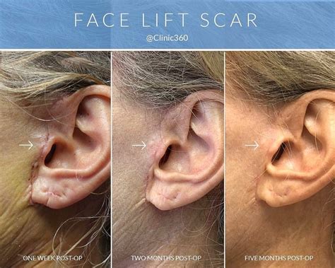 Clinic360 How Visible Are Facelift Scars 👉 Most Of The Face Lift