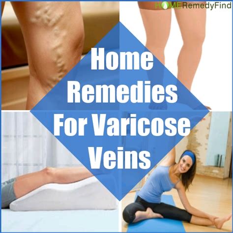10 Best Home Remedies For Varicose Veins Diy Find Home