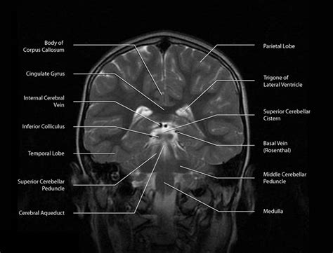 MRI-03 Coronal, Section 12