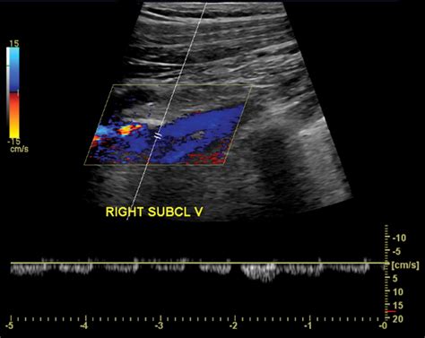 Venous Doppler Sonography Of The Extremities A Window To Pathology Of The Thorax Abdomen And