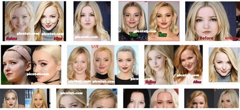 Dove Cameron Plastic Surgery Before And After American Actress And