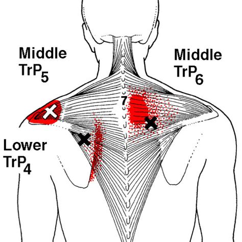 Intermediate back muscles and c other muscles in the back are associated with the movement of the neck and shoulders. Referred pain patterns (red) from the upper and lower ...