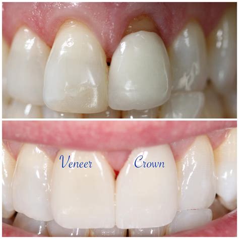 A Complete Guide To Porcelain Veneers Waterden Dental