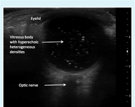 Diagnostic Ultrasound Image Of A Vitreous Hemorrhage The Vitreous