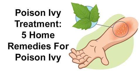 How To Use Apple Cider Vinegar For Poison Ivy Ostomy Lifestyle
