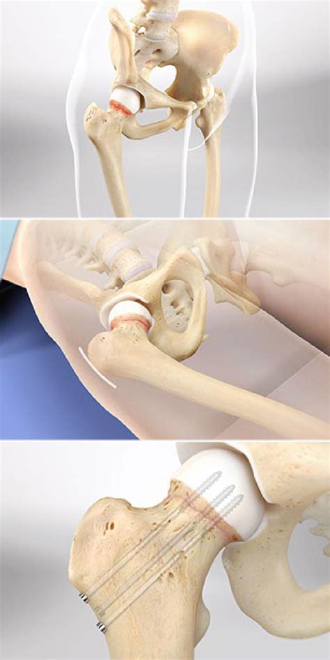Hip Fracture Treatment With Surgical Screws Orthopaedic Associates Of