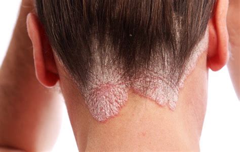 Tips For Living With Scalp Psoriasis Windsor Dermatology