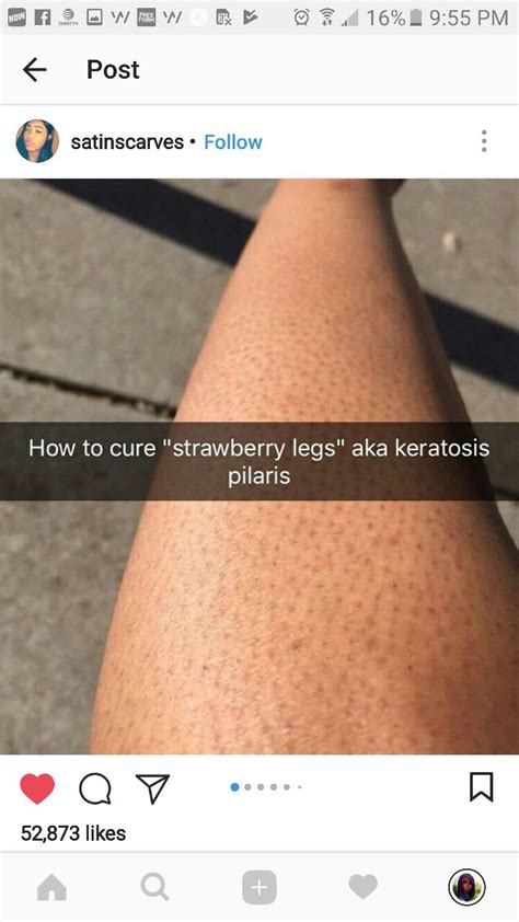 Pin By Novi On Skin Disease Get Rid Of Strawberry Legs Strawberry
