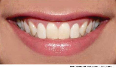 Perception Of Smile Aesthetics By Dental Specialists And Patients
