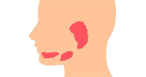 Swelling Of The Parotid Gland 5 Causes You Should Know