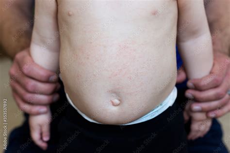 Belly Of Baby With Atopic Dermatitis Eczema Showing Typical Itchy