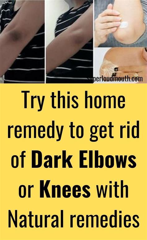 9 Proven Ways To Get Rid Of Dark Elbows And Knees With Images Dark