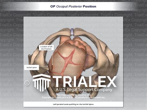 Op Occiput Posterior Position Trialexhibits Inc