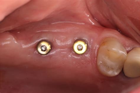 Unveiling The Mysteries Of Dental Implant Healing Caps