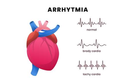 Premium Vector Cardiac Disease Arrhythmia With A Heart And Pulse Ecg