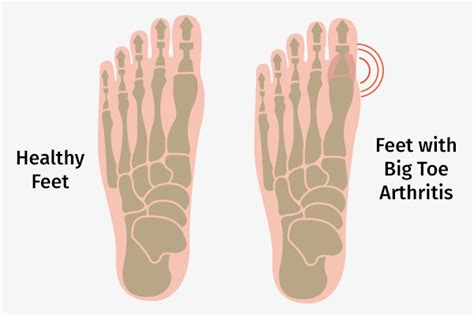 How To Treat Arthritis Of The Big Toe Emedihealth