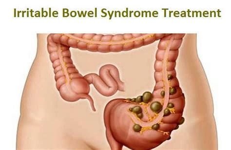 Management Of Irritable Bowel Syndrome