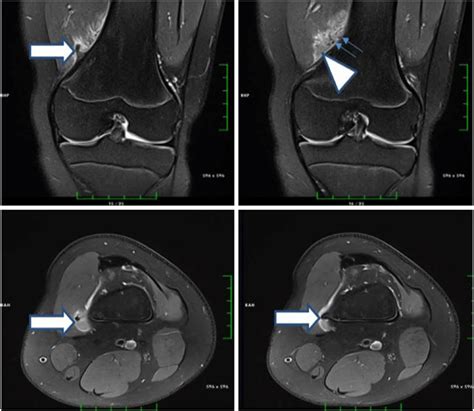 Axial And Coronal Fat Saturated Proton Density Images Showing Download Scientific Diagram