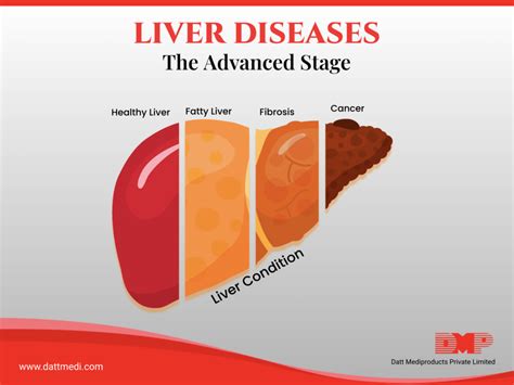 The Advanced Stages Liver Diseases Blog By Datt Mediproducts