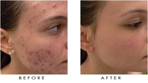 Acne Treatment Trillium Laser