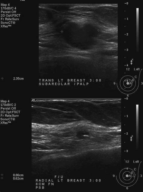 Left Breast Subareolar Biopsy Proven Malignancy Baseline Ultrasound