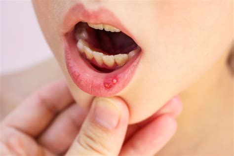 Lets Learn About Canker Sores
