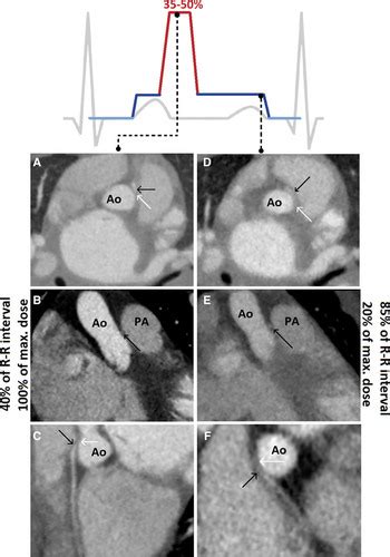 Submillisievert Multiphasic Coronary Computed Tomography Angiography