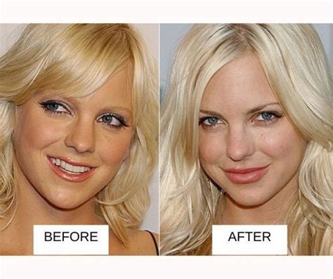 25 Most Popular Celebrities With Lip Fillers Before And After With
