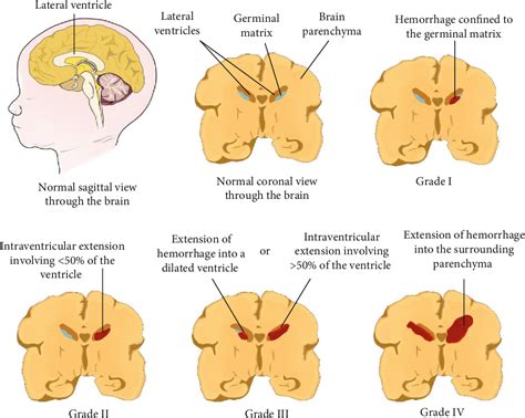 Pdf Germinal Matrix Intraventricular Hemorrhage A Tale Of Preterm