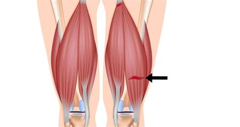 What Should You Not Do With A Pulled Hamstring Essential Tips