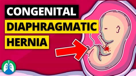 Congenital Diaphragmatic Hernia Medical Definition Explainer Video