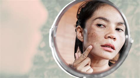 Dark Spots On Face Melasma Causes And Treatment
