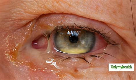 Know All About Common Eye Infections From Ophthalmologist Onlymyhealth