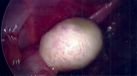 Dermoid Cyst — Dr Jenny Cook